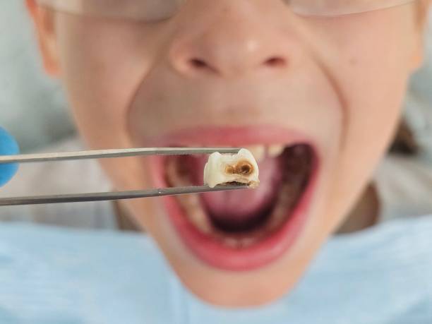 Best Emergency Treatment for Toothache in Gholson, TX